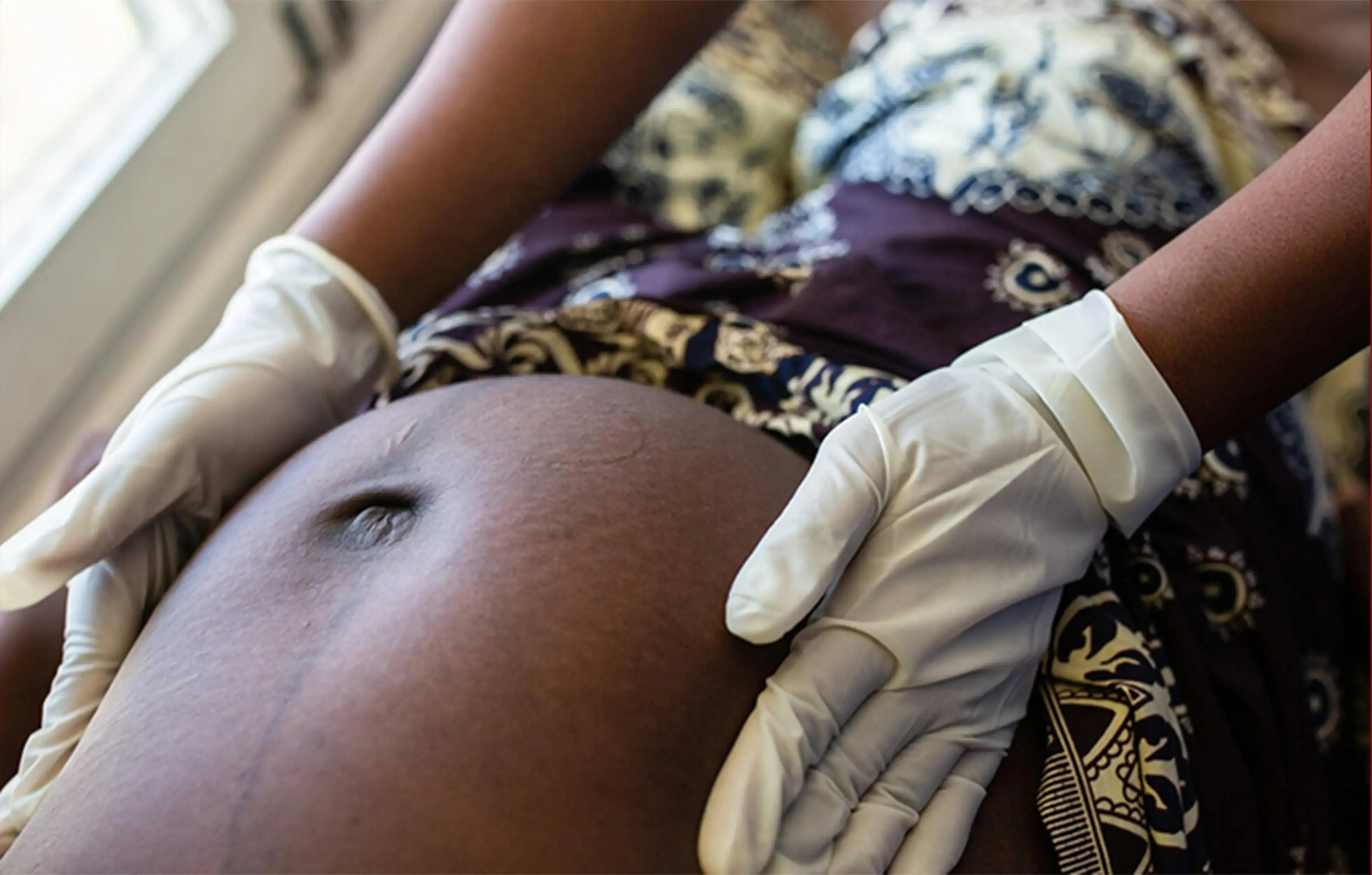 Obstetric fistula